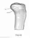 Fig. 65 - Arthroplasty jigs with mating accuracy
