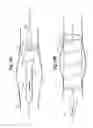 Fig. 08 - Reinforced graft prosthesis