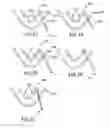 Fig. 16 - Tissue Fixation Systems, Delivery Tools, and Associated Methods and Kits