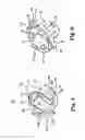 Fig. 04 - Valve delivery device