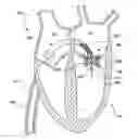 Fig. 01 - CATHETER-BASED DELIVERY DEVICE HAVING SEGMENT WITH NON-UNIFORM WIDTH HELICAL SPINE