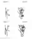 Fig. 33 - Atrio-ventricular valve stent with native leaflet grasping and holding mechanism