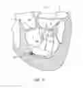 Fig. 06 - Papillary muscle adjustment