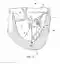 Fig. 08 - Papillary muscle adjustment
