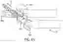 Fig. 28 - Spinal joint implant delivery device and system