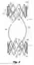 Fig. 03 - Fatigue-resistant flow regulating device and manufacturing methods
