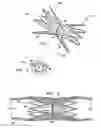 Fig. 02 - VASCULAR IMPLANT