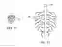 Fig. 06 - Method of treating atherosclerotic occlusive disease
