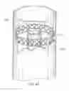 Fig. 15 - Method of treating atherosclerotic occlusive disease
