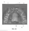 Fig. 09 - Fabrication of maxillofacial splints