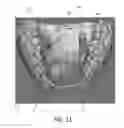 Fig. 10 - Fabrication of maxillofacial splints