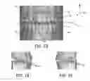 Fig. 12 - Fabrication of maxillofacial splints