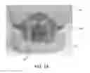 Fig. 16 - Fabrication of maxillofacial splints