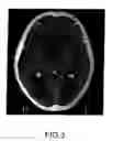 Fig. 04 - Method and system for reducing the likelihood of a porphyromonas gingivalis infection in a human being