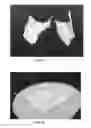 Fig. 07 - SKIN-PROTECTIVE HYDROGEL WOUND DRESSING