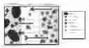 Fig. 01 - FACTOR CONCENTRATION GAUZE COMBINED WITH ENDOTHERMIC REACTION USED TO COMBAT VERY PROXIMAL TRAUMATIC AMPUTATION HEMORRHAGING