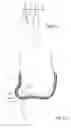 Fig. 09 - Disposable pant-type absorbent article