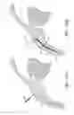 Fig. 66 - Implants with controlled drug delivery features and methods of using same