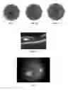 Fig. 02 - Method of treating macular degeneration using botulinum toxin-based pharmaceuticals
