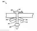 Fig. 01 - Catheter snugger system and method