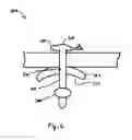 Fig. 03 - Catheter snugger system and method
