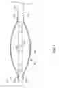 Fig. 02 - Lithotripsy Angioplasty Devices and Methods
