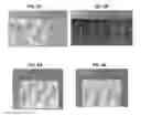 Fig. 04 - Multi-component bio-active drug delivery and controlled release to the skin by microneedle array devices