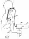 Fig. 06 - ESOPHAGEAL RETRACTOR WITH SENSOR