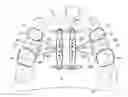 Fig. 01 - Dual expanding palatal distractor