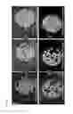 Fig. 16 - Method and compositions for inhibiting or preventing adverse effects of oral antibiotics