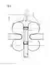 Fig. 06 - Trans-anal inflow catheter for intermittently triggering a reflex-coordinated defecation