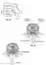 Fig. 02 - Treatment of spinal tissue