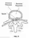 Fig. 10 - Treatment of spinal tissue