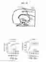 Fig. 17 - Method for treating schizophrenia