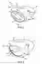 Fig. 02 - Variable thickness face plate for a golf club head
