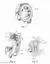 Fig. 02 - Clearance-free self-aligning bearing on the decoupling tensioner