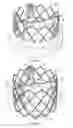 Fig. 02 - Devices and methods of commissure formation for prosthetic heart valve