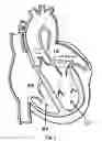 Fig. 02 - Method and Design for a Mitral Regurgitation Treatment Device