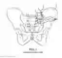 Fig. 02 - Sacroiliac joint fusion system