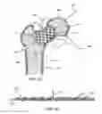 Fig. 02 - Femoral neck support structure, system, and method of use