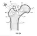 Fig. 06 - Femoral neck support structure, system, and method of use