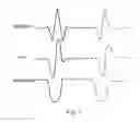 Fig. 06 - Method and apparatus for enhancement of chest compressions during CPR