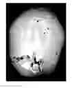 Fig. 01 - Methods for treating craniosynostosis in a patient