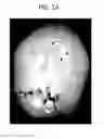 Fig. 02 - Methods for treating craniosynostosis in a patient