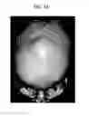Fig. 07 - Methods for treating craniosynostosis in a patient