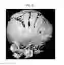 Fig. 08 - Methods for treating craniosynostosis in a patient