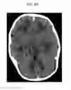 Fig. 09 - Methods for treating craniosynostosis in a patient
