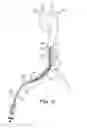 Fig. 12 - COATED BALLOONS FOR BLOOD VESSEL STABILIZATION