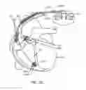 Fig. 75 - Ground electrical path from an MLCC filter capacitor on an AIMD circuit board to the ferrule of a hermetic feedthrough