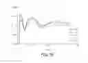 Fig. 10 - Brain stimulation therapy